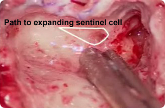 Sentinel Cell expanded